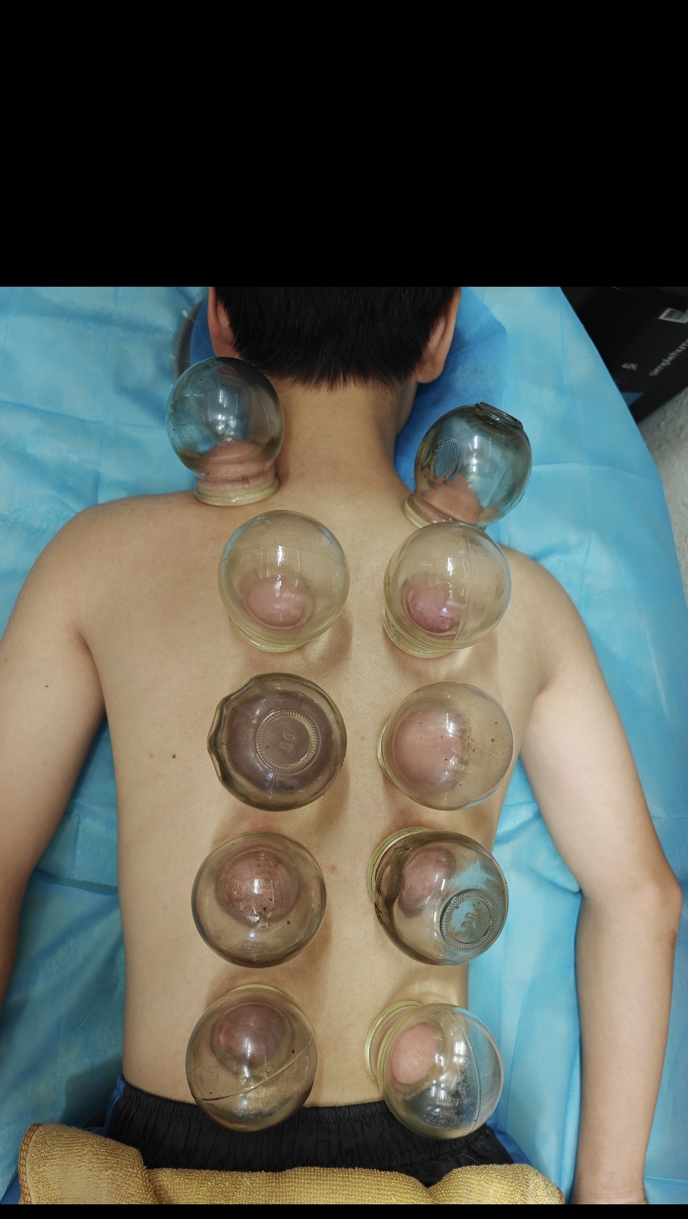 玻璃拔罐／走罐療法